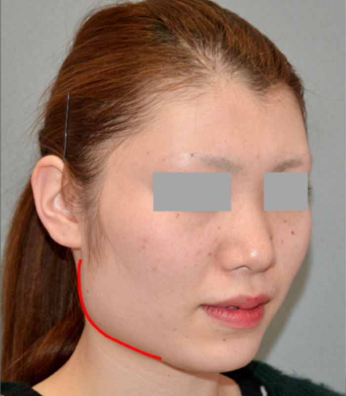 下顎角部の張り出し(隆起)が目立ち顔の余白が広い方