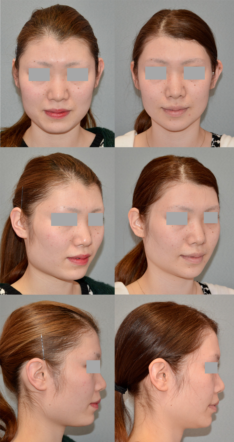 エラ施術の症例写真