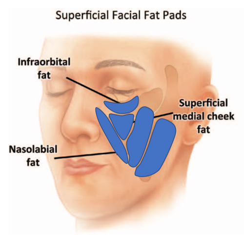 カニューラの種類