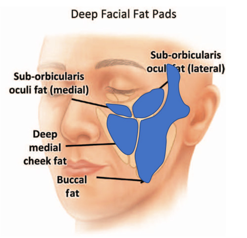 カニューラの種類
