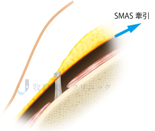 カニューラの種類