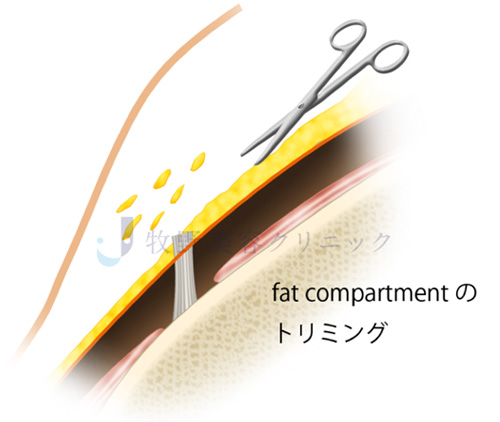 カニューラの種類