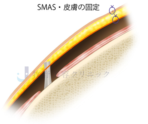 カニューラの種類