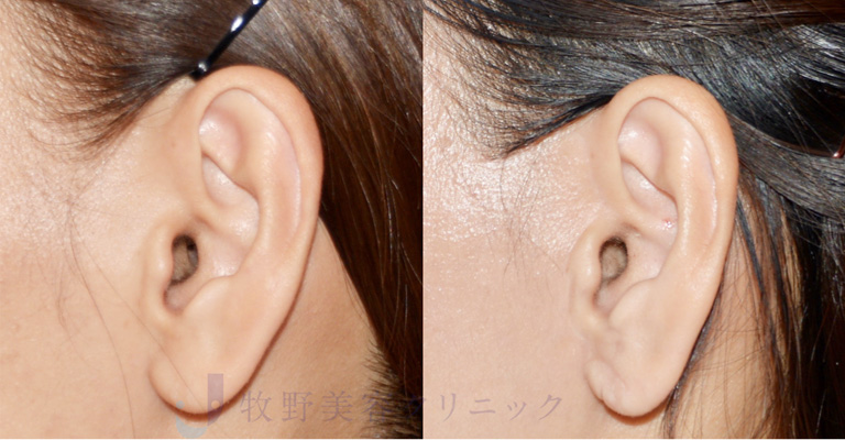 カニューラの種類