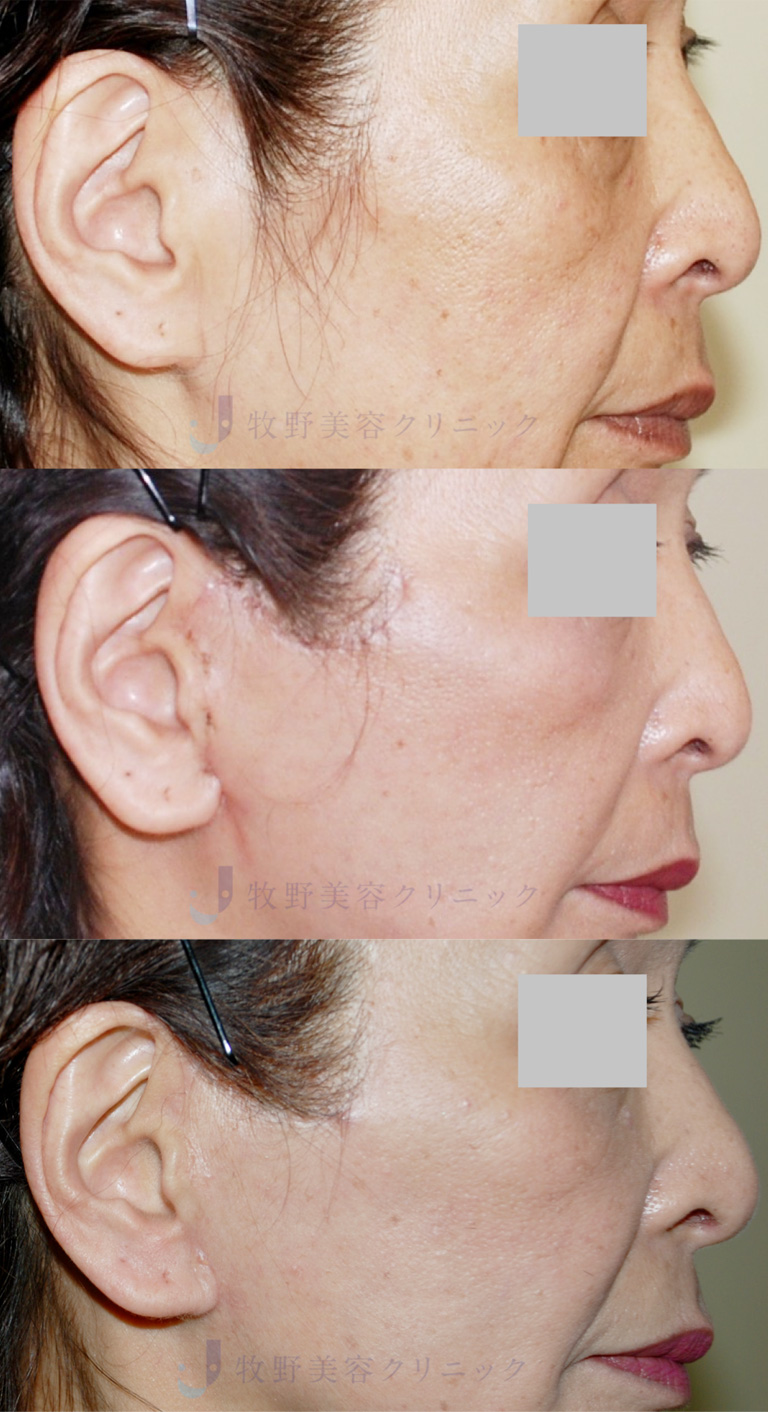 カニューラの種類