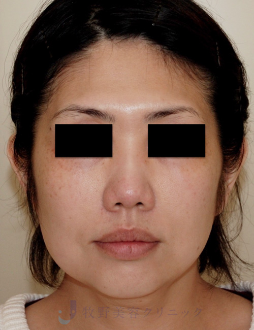 カニューラの種類