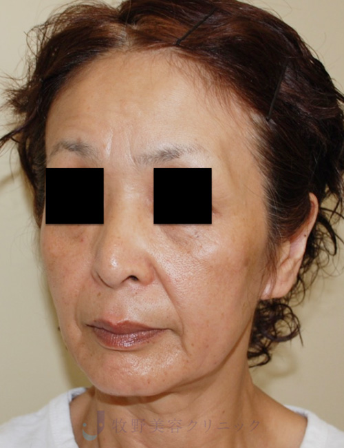 カニューラの種類