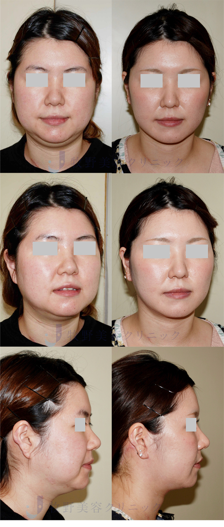 カニューラの種類