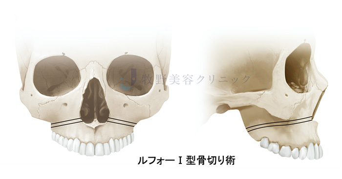 ルフォーI型骨切り術