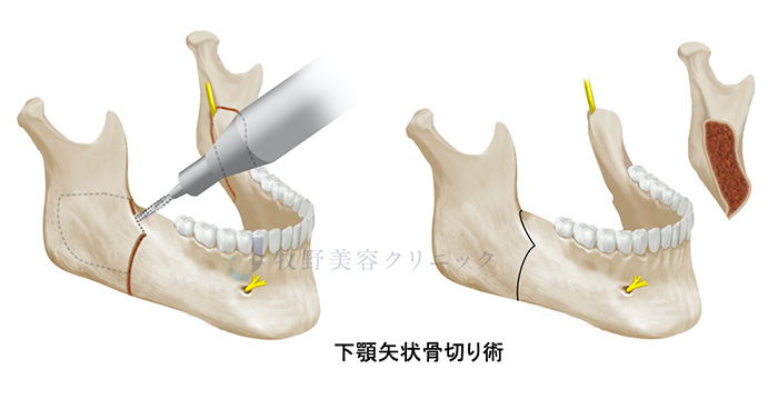 下顎矢状骨切り術