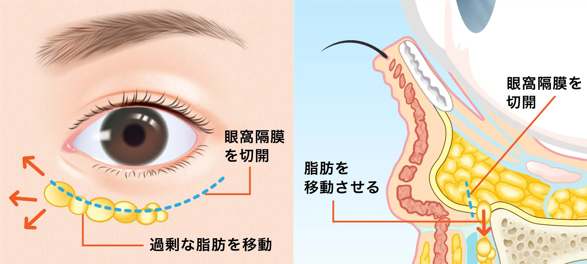 余分な脂肪を移動