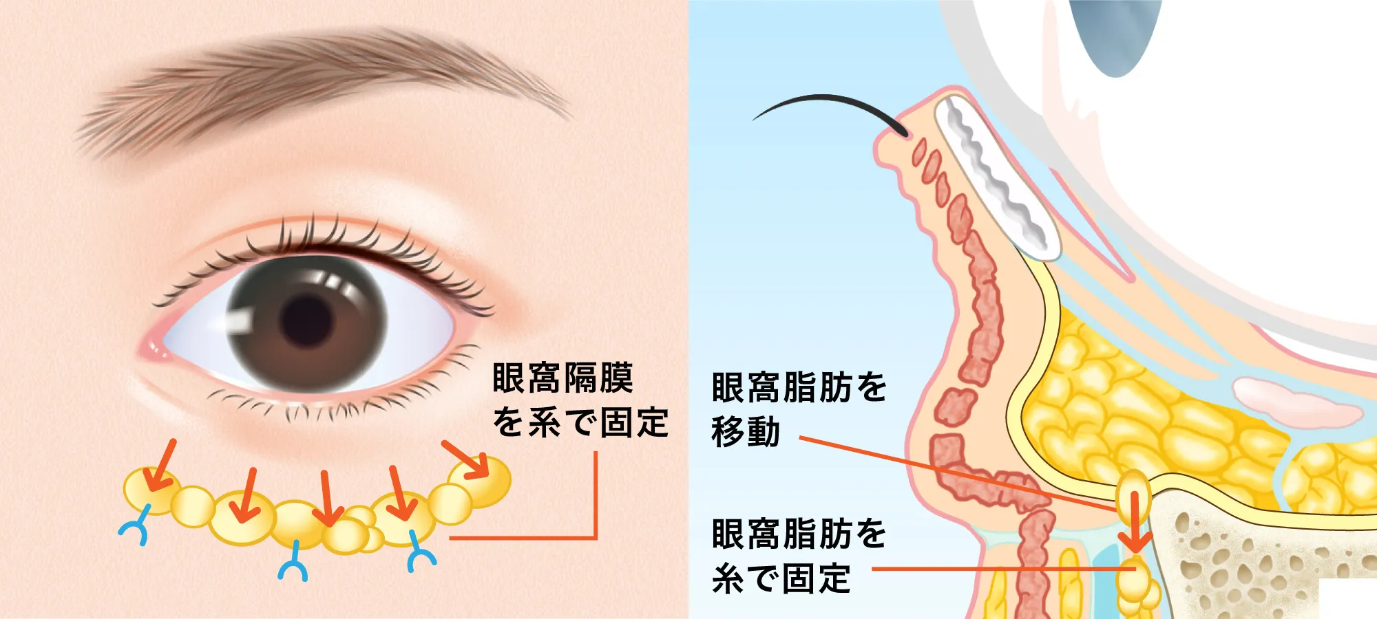 脂肪を糸で固定