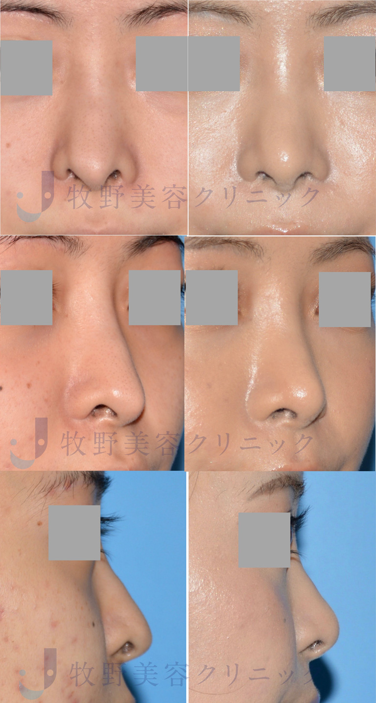 鼻中隔延長術・鼻孔縁下降術・鼻翼修正