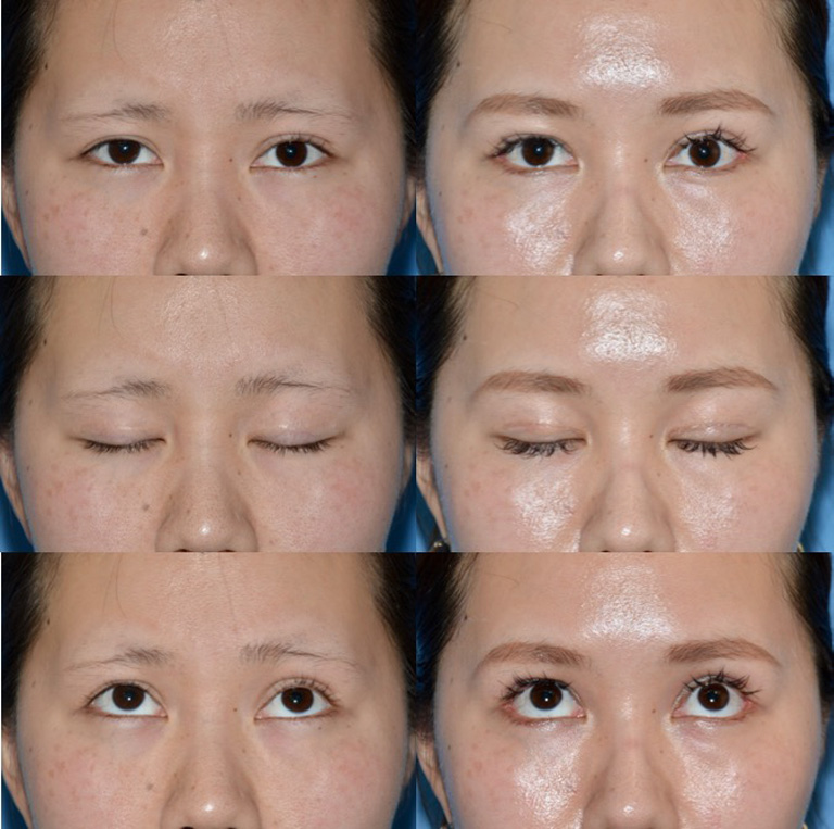 二重切開法(他院修正）・眼瞼下垂症手術・目尻切開術・下眼瞼下制術（グラマラスライン）