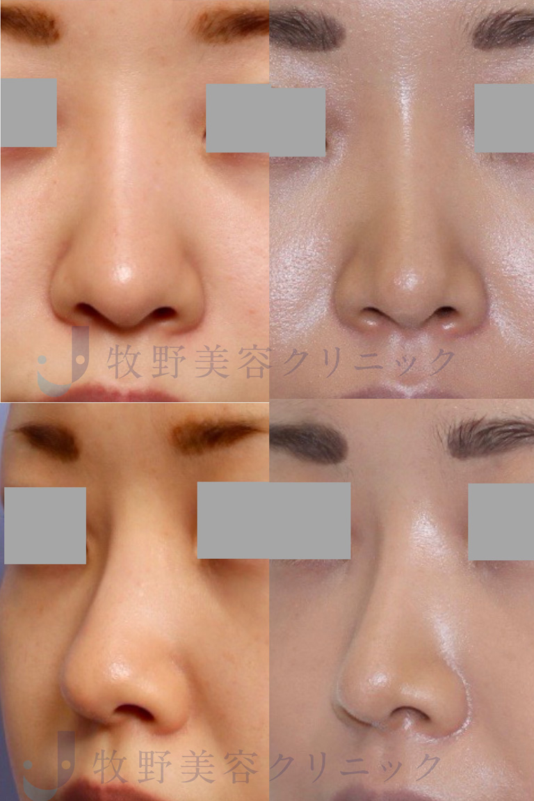 鼻尖縮小術・他院鼻プロテーゼ位置修正