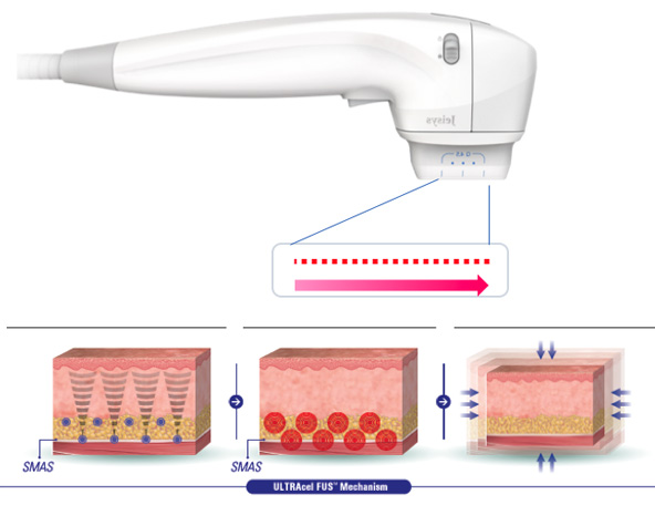 深さの異なる深部で熱収縮が起こることにより、三次元的に収縮